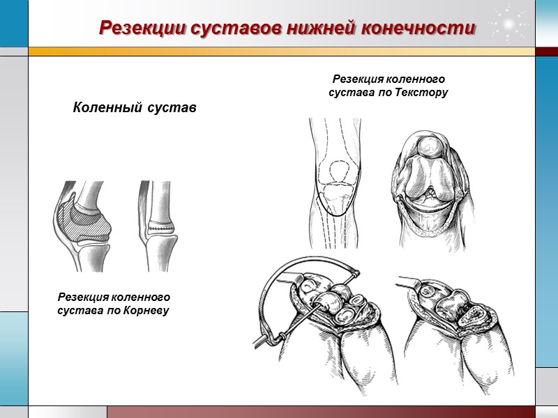 Резекции суставов нижней конечности Коленный сустав Резекция коленного сустава по Корневу Резекция коленного сустава